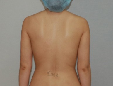 팔뚝지방흡입12.jpg