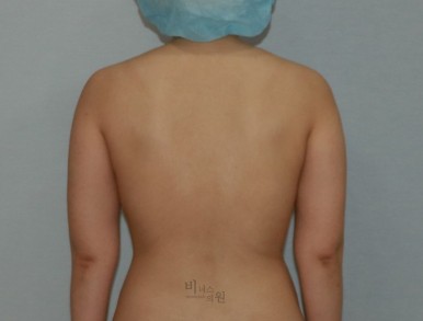 팔뚝지방흡입11.jpg