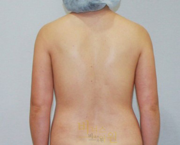 팔뚝지방흡입6.jpg