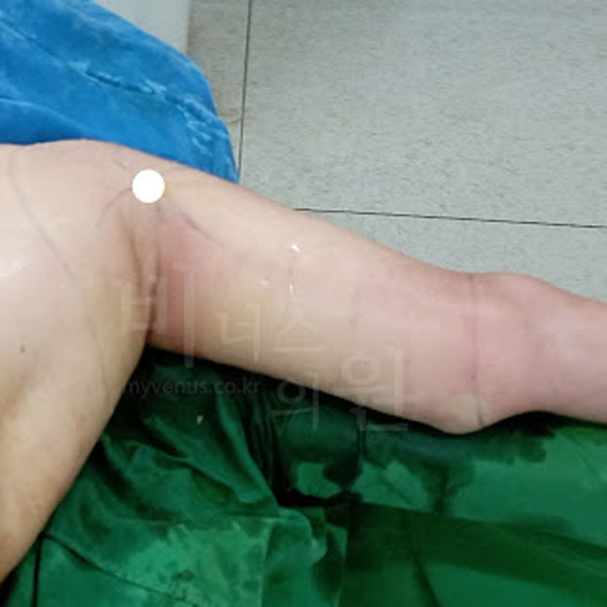 슬림해진 팔 라인과 줄어든 팔뚝 둘레.jpg