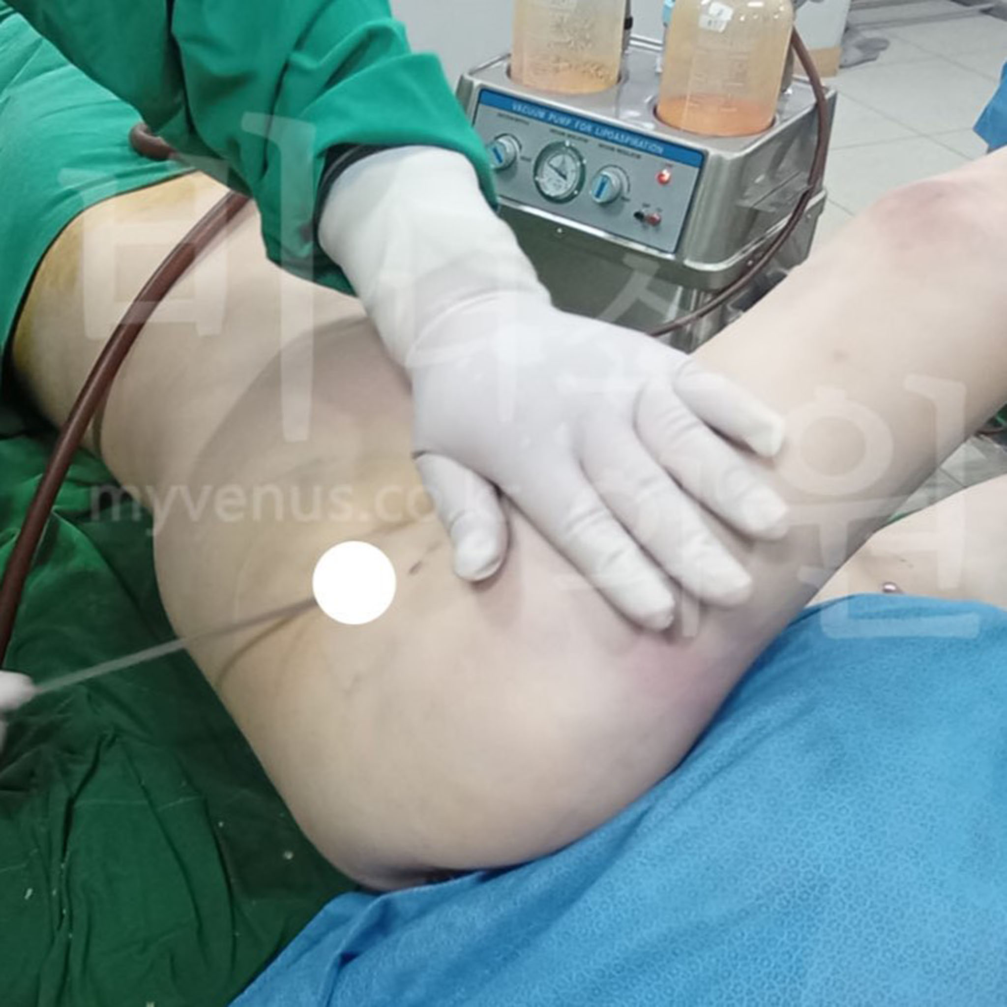 팔뚝 지방흡입 전후 비교 사진.jpg