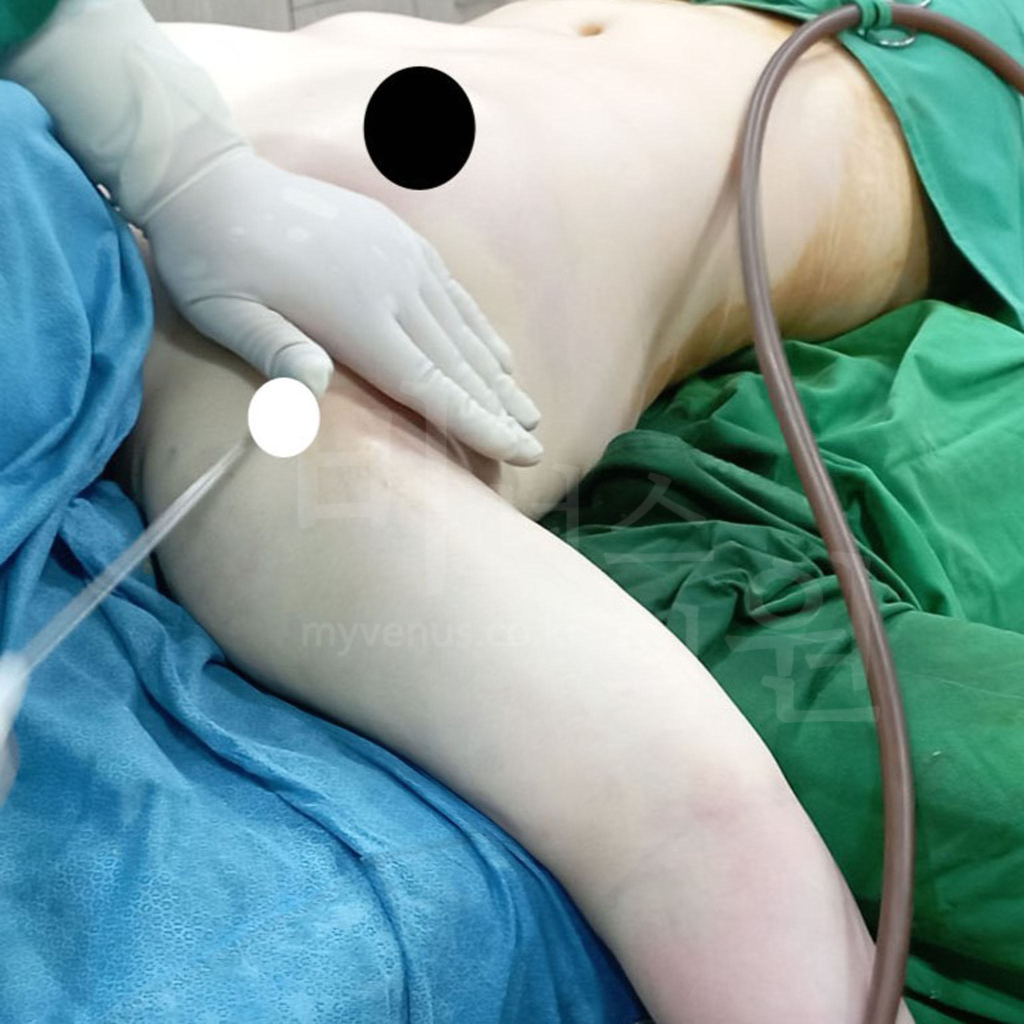 팔뚝 지방흡입 회복 과정.jpg