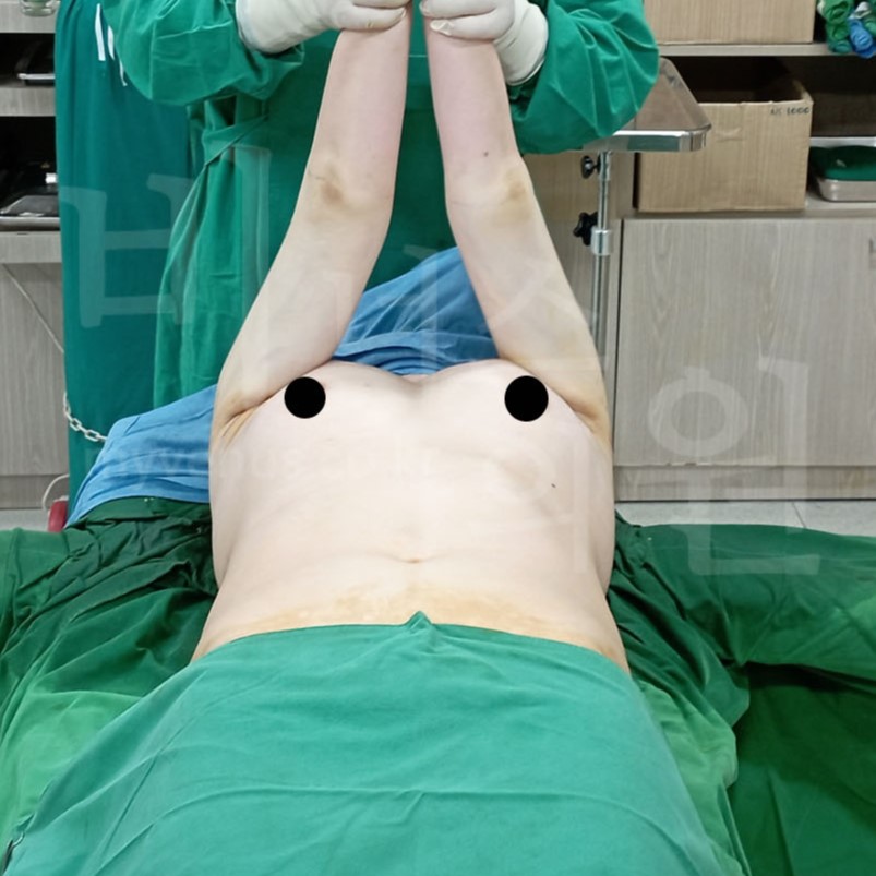 지방흡입 회복 과정.jpg