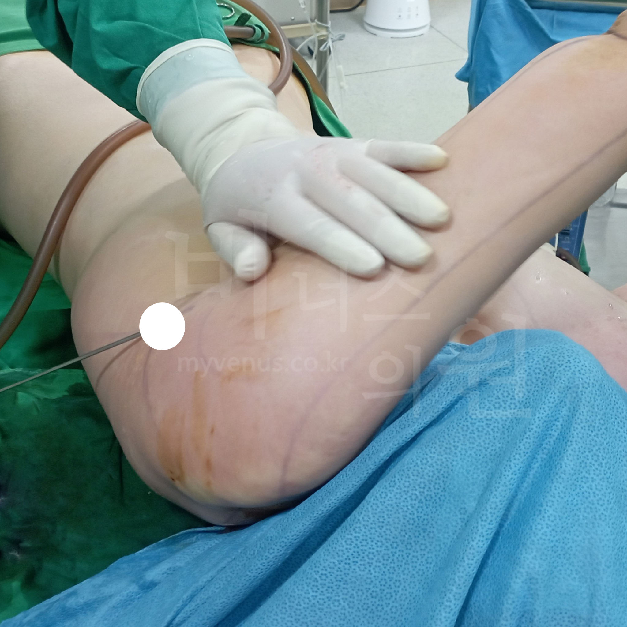 팔뚝 지방흡입 후 압박복 착용.jpg