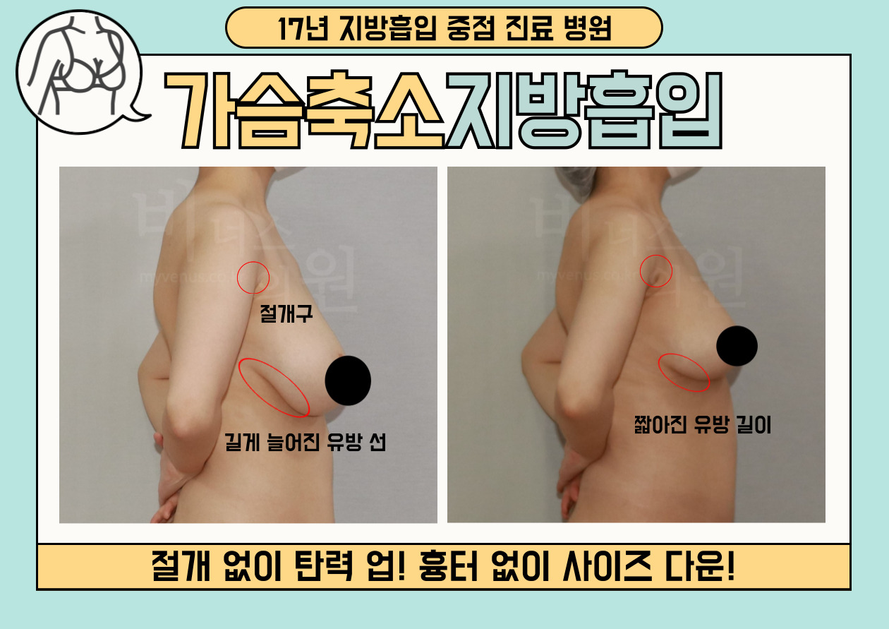유방축소 지방흡입.jpg