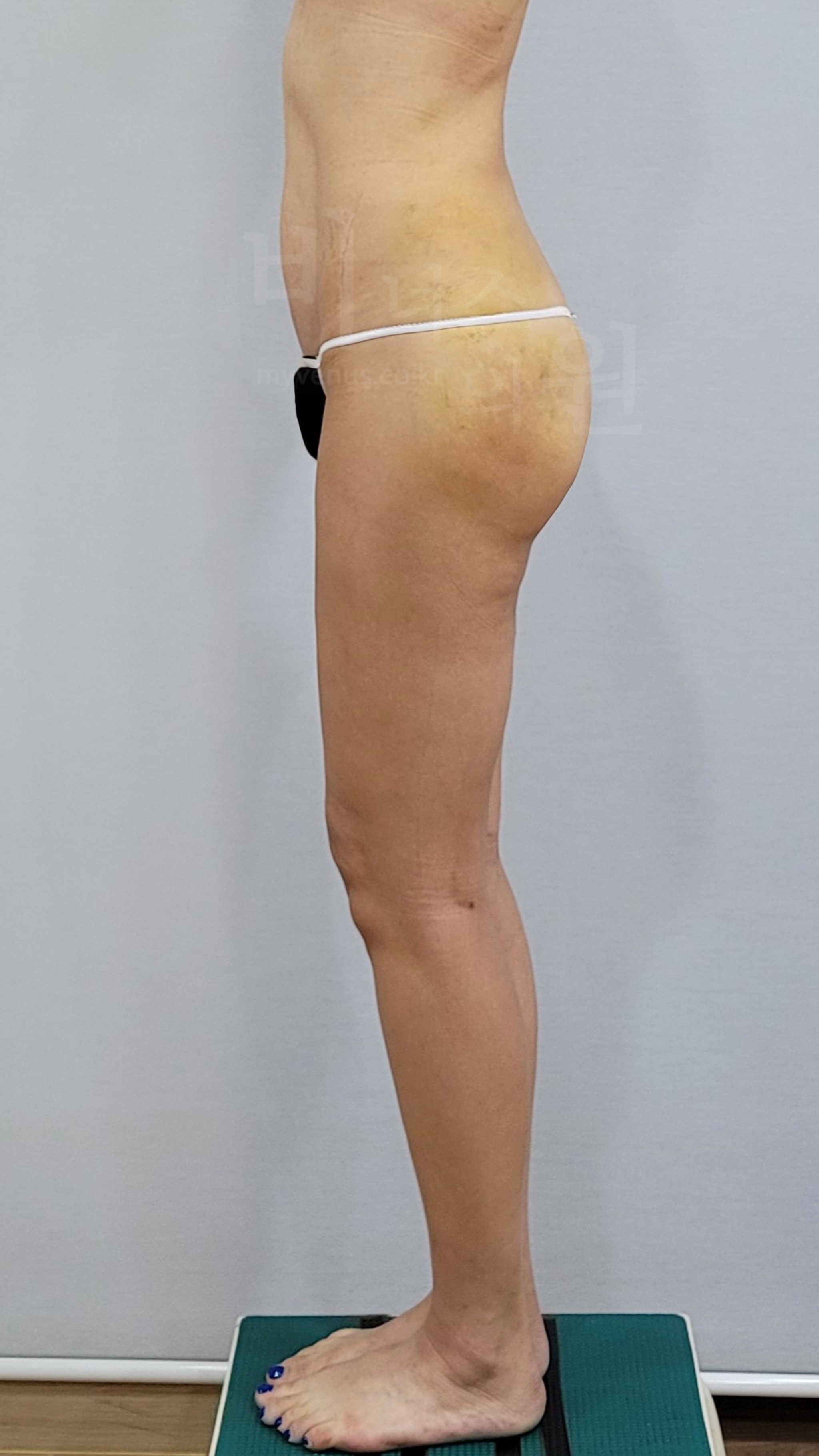 인천 엉덩이 지방이식.jpg