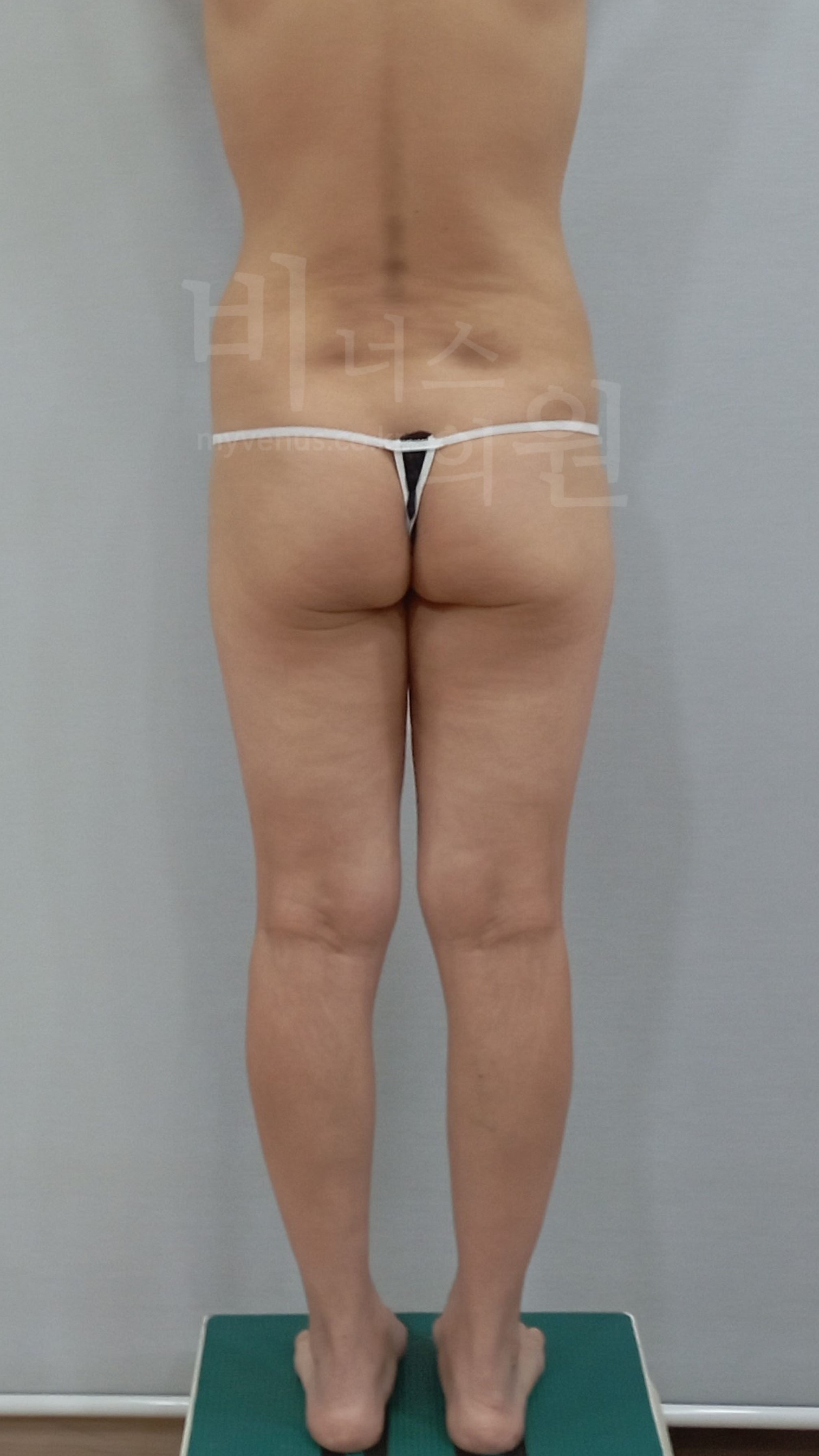 엉덩이 확대 지방이식.jpg