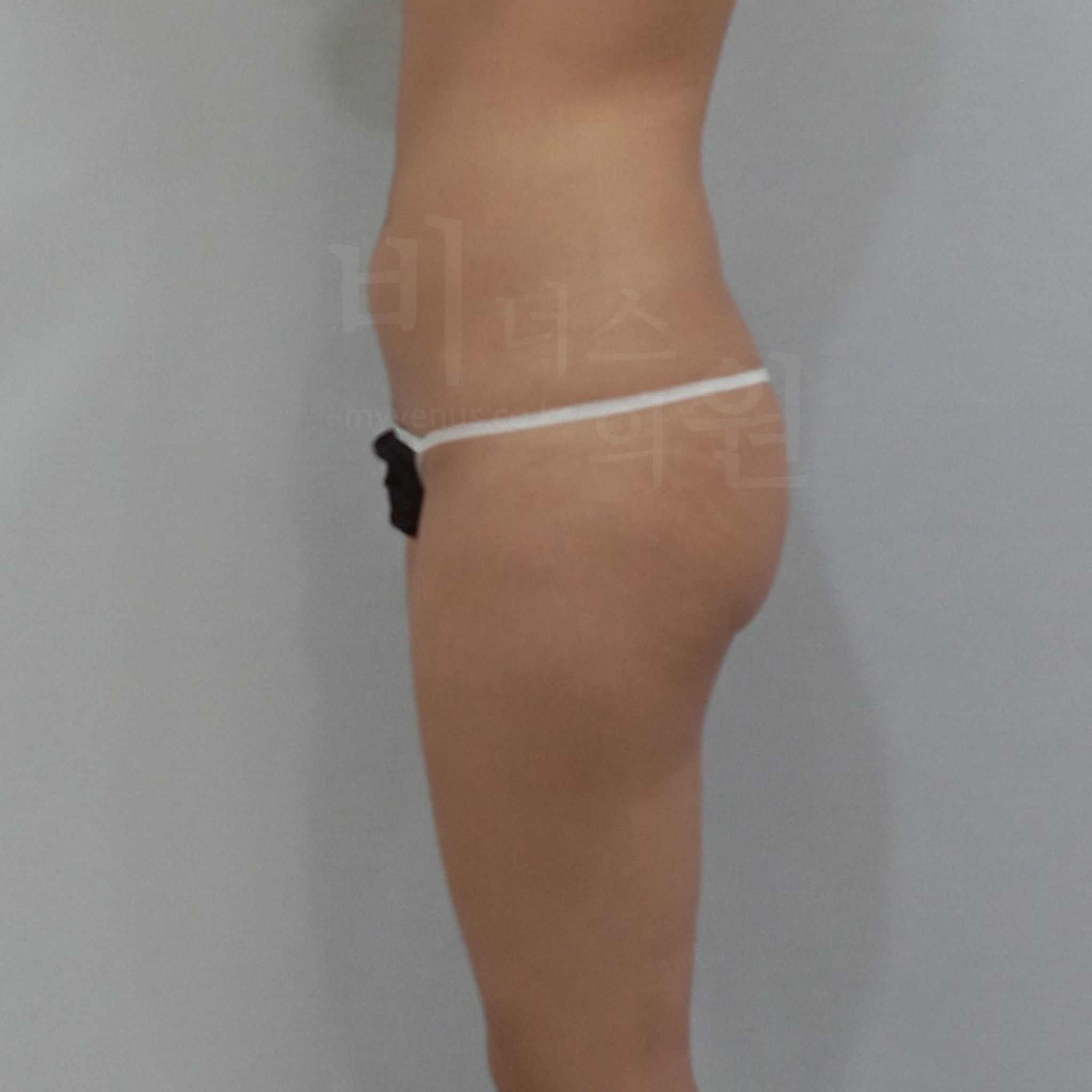 엉덩이 확대 수술.jpg