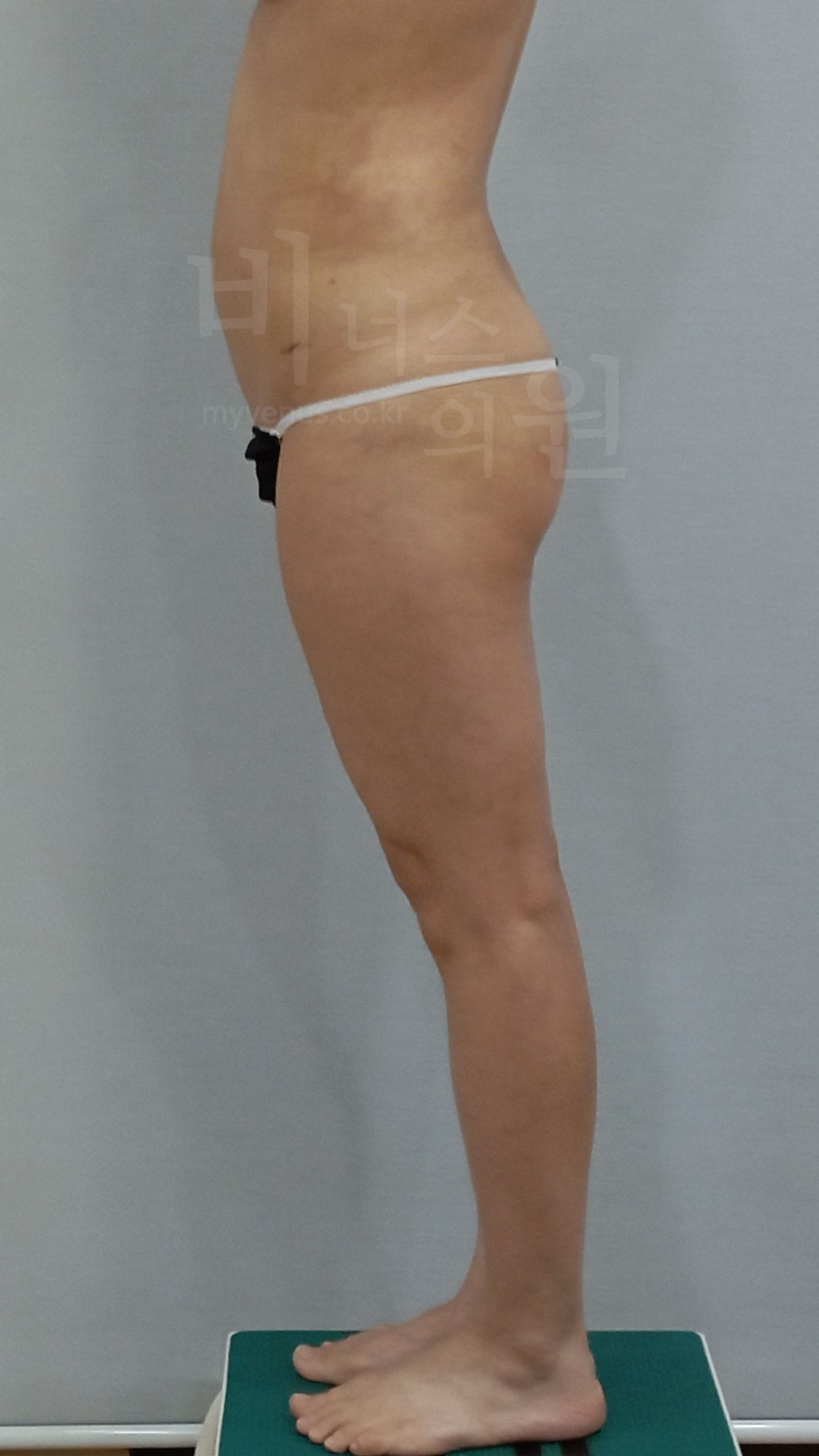 힙업 지방이식 후기.jpg