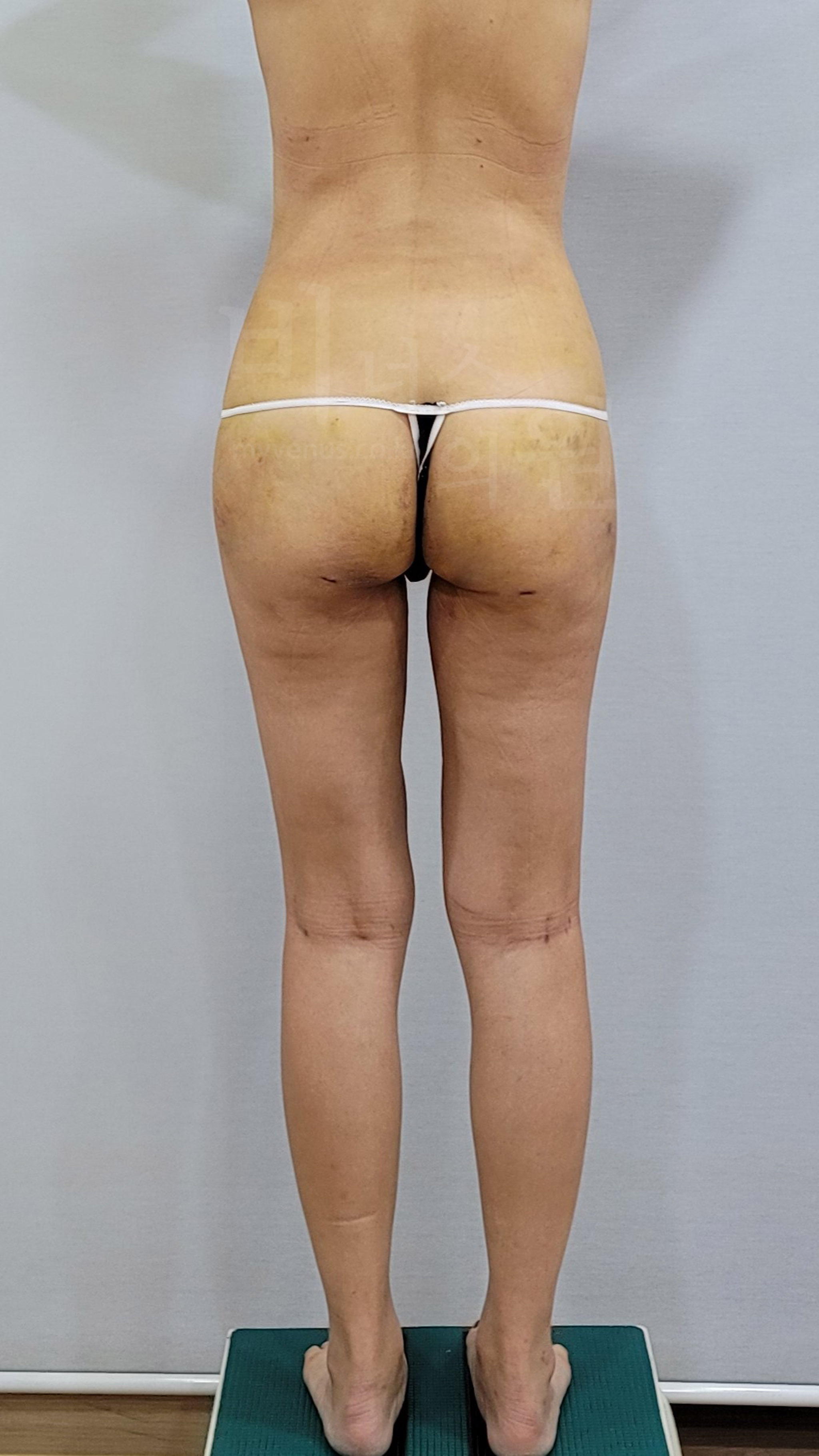 엉덩이 지방흡입 전후 사진.jpg