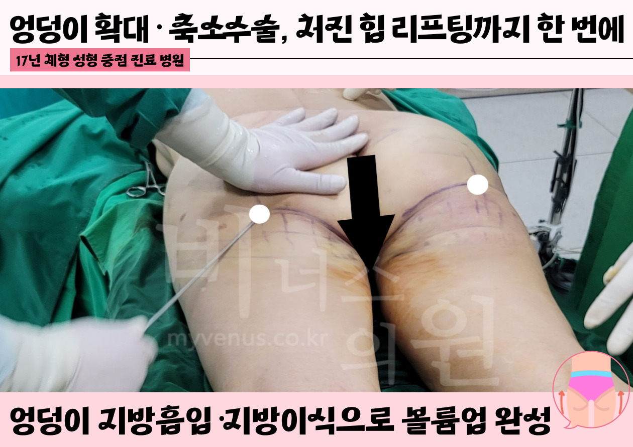 엉덩이지방흡입.jpg