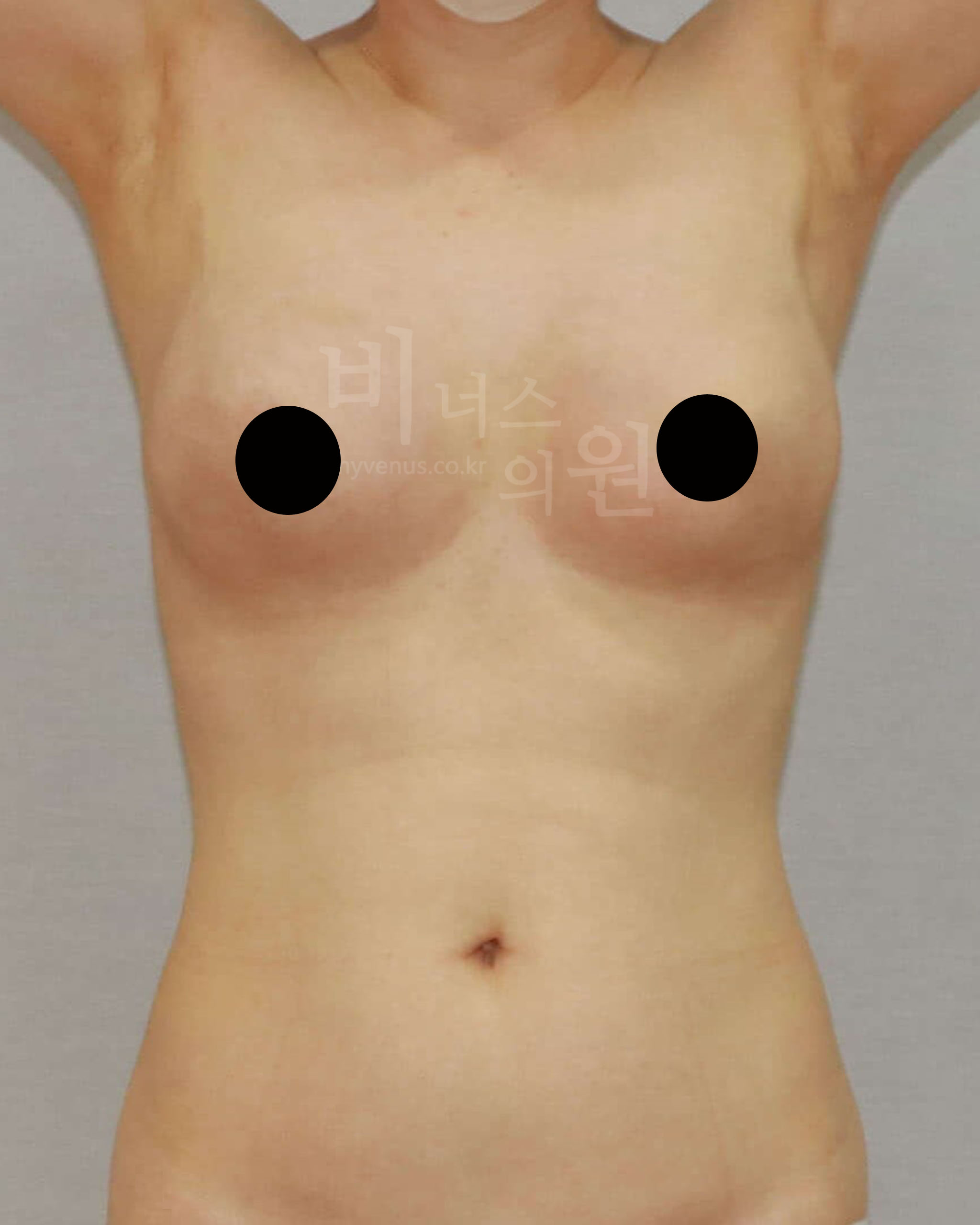 가슴지방흡입 전후 후기.jpg