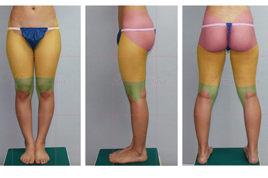 허벅지 지방흡입 부위.jpg