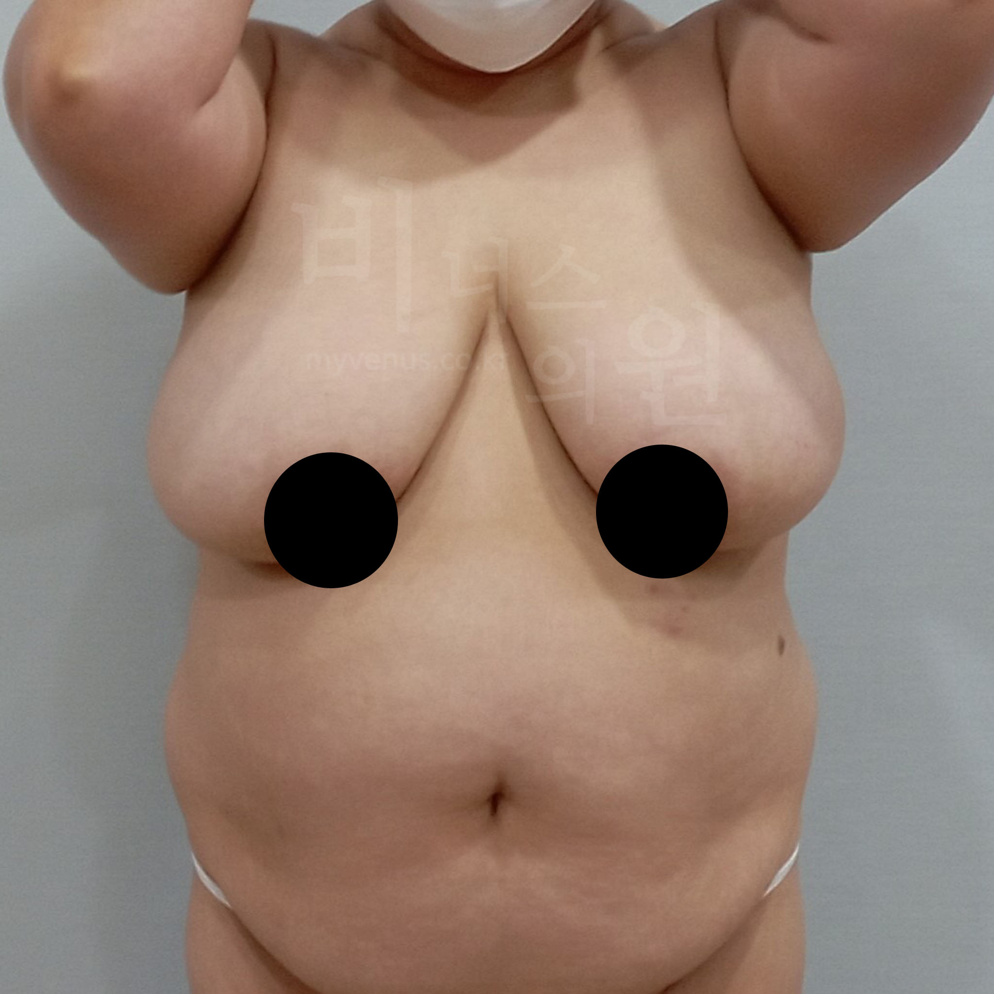 가슴축소지방흡입_1 2025012.jpg