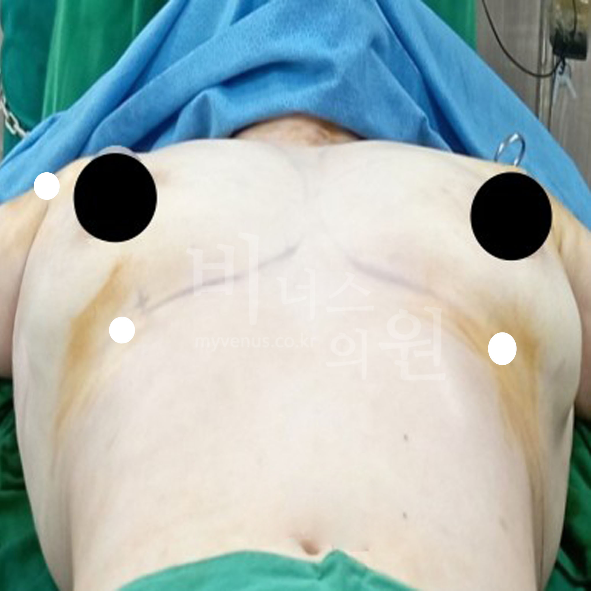 가슴성형 후.jpg