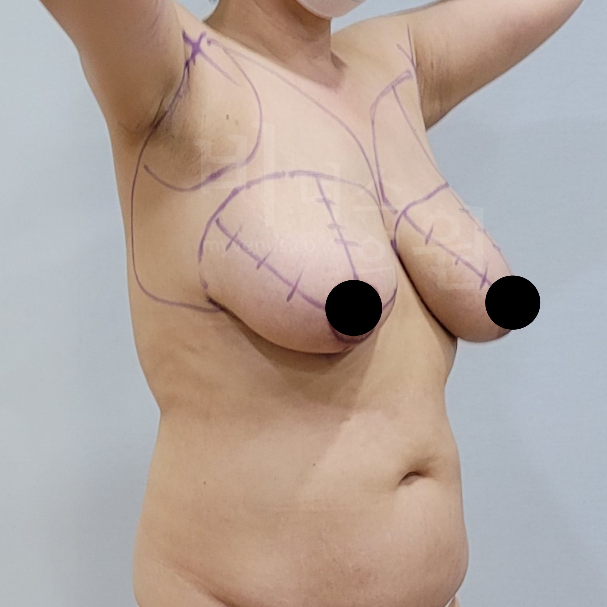 가슴 볼륨 감소.jpg