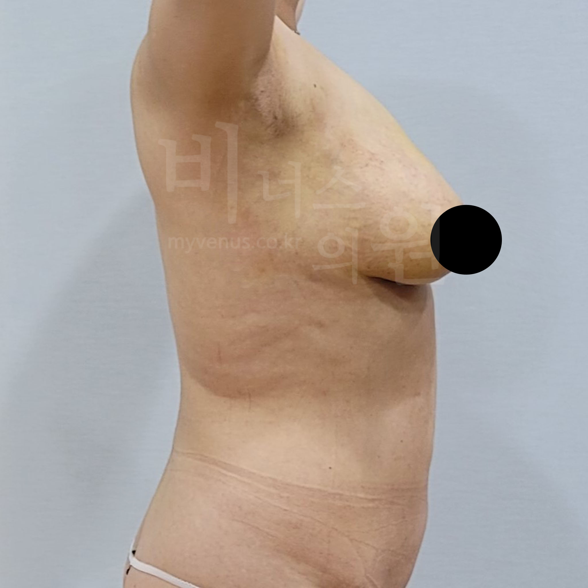 절개 없는 가슴축소.jpg