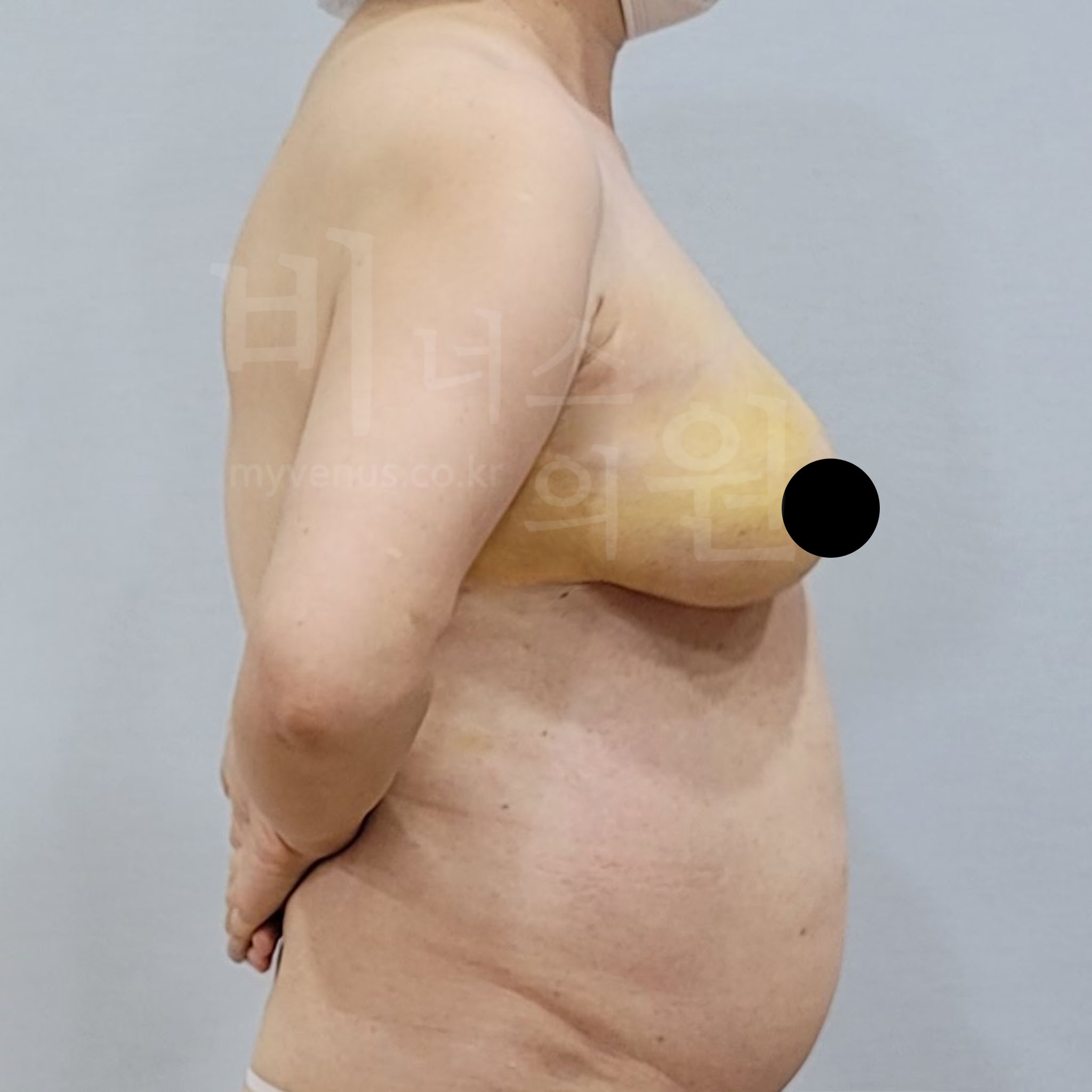 지방흡입 통증.jpg