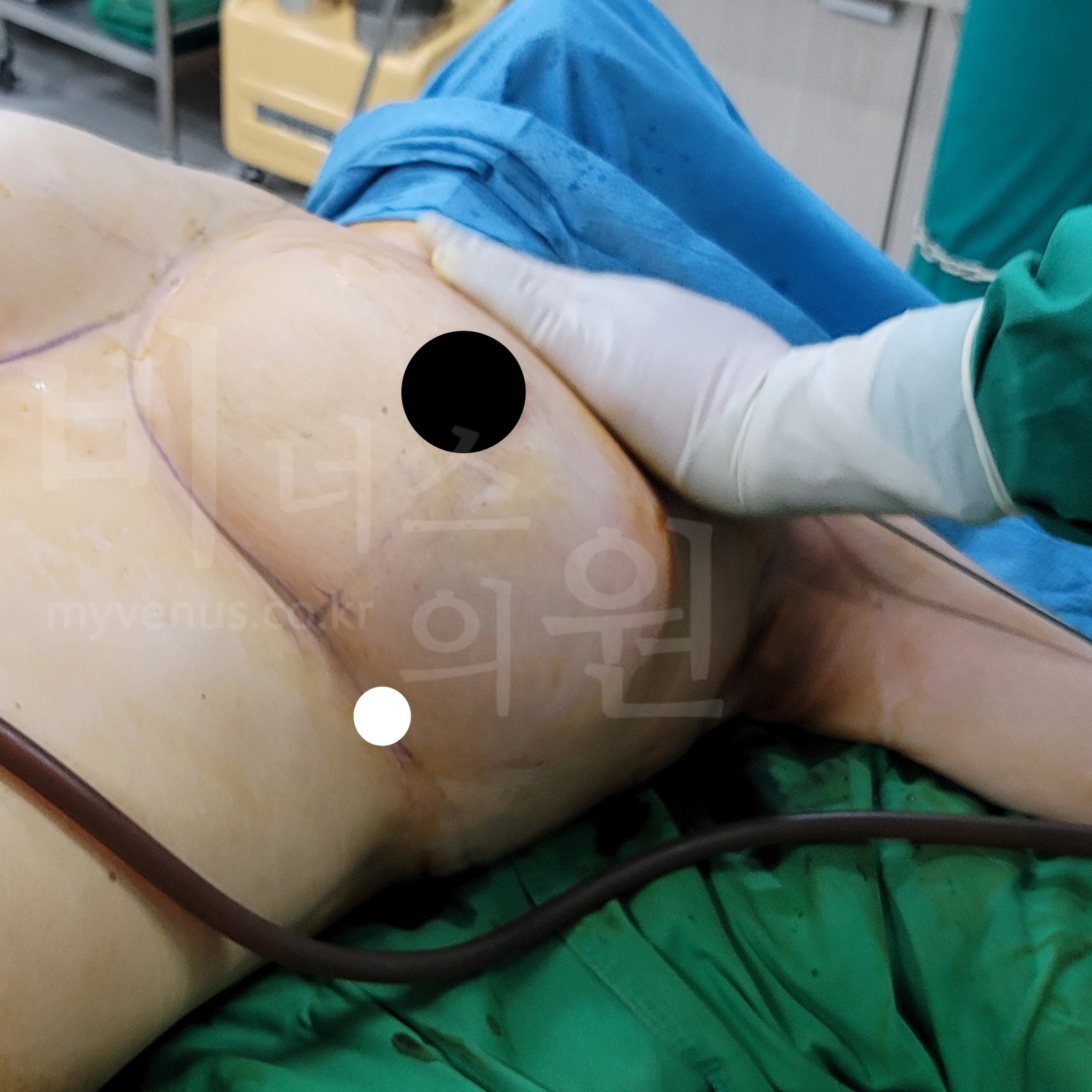 부유방 제거.jpg