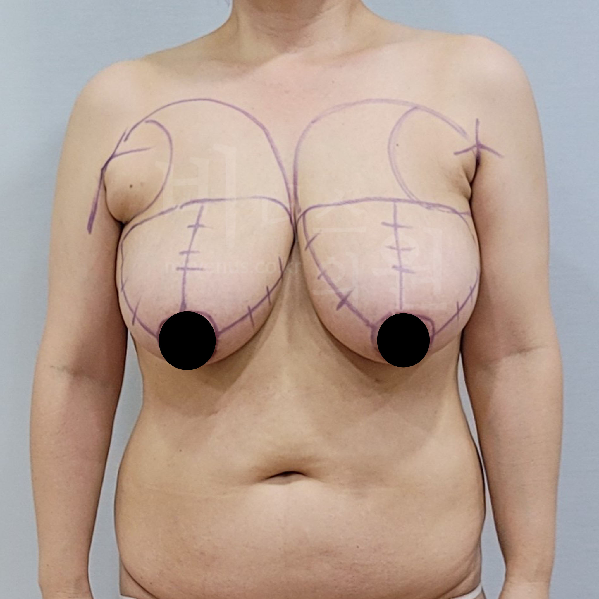 가슴축소 관리.jpg