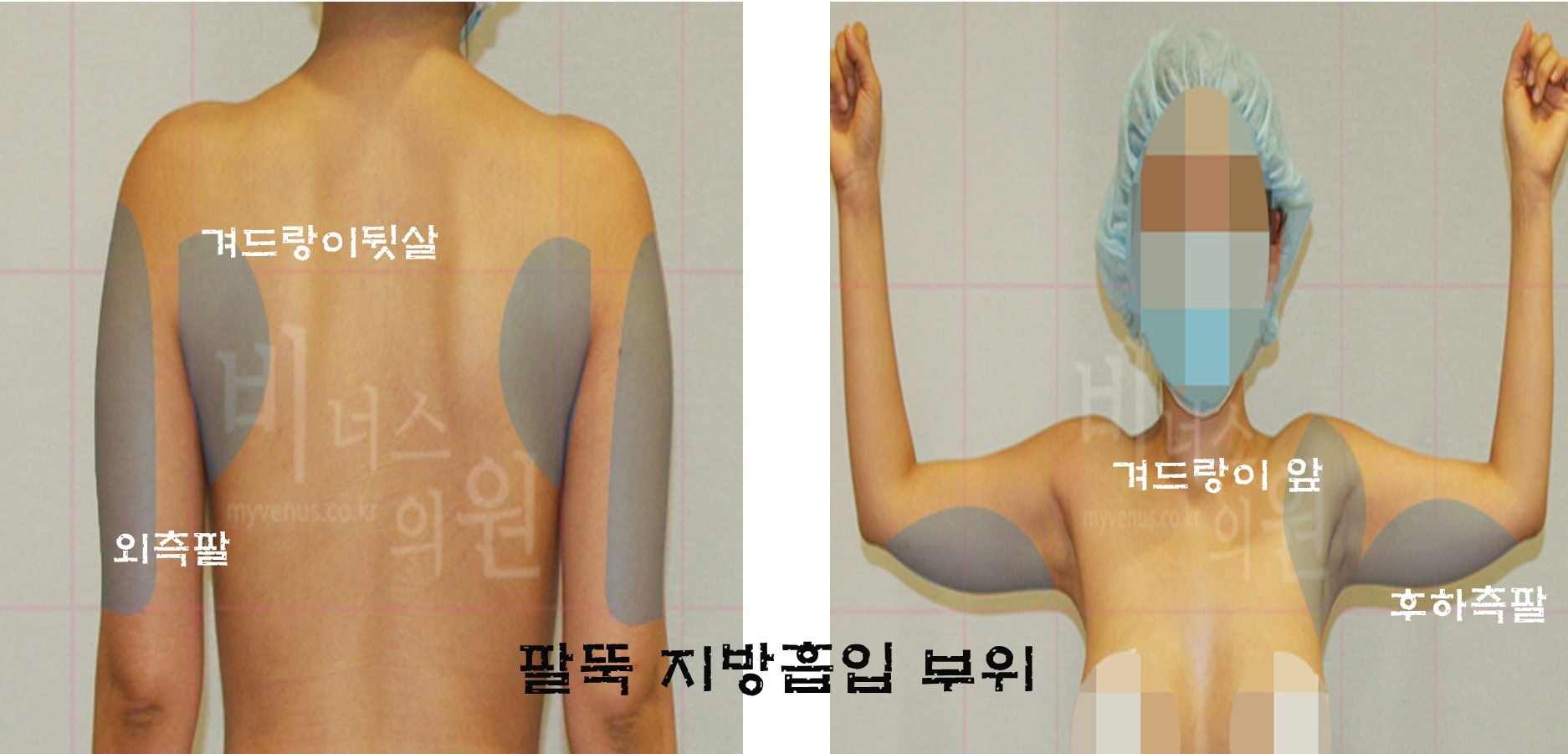 팔뚝지방흡입부위.jpg