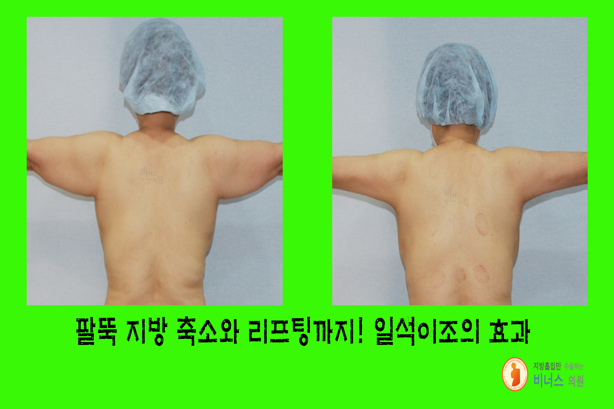 팔뚝지방 일석이조.jpg