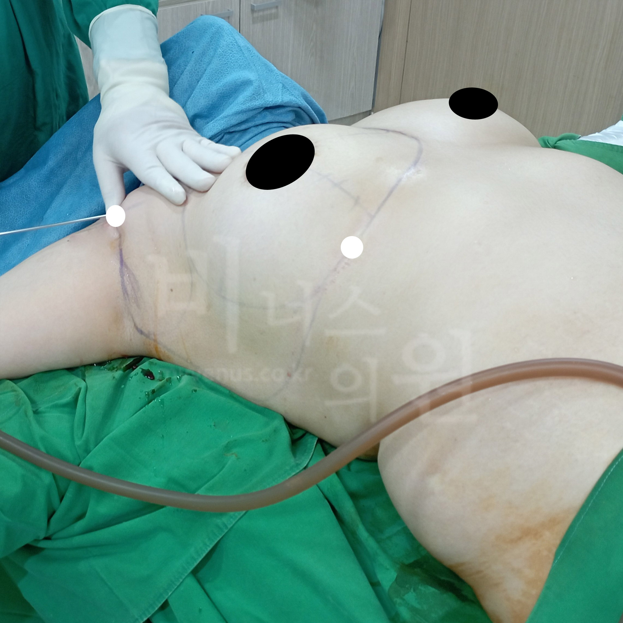 유방라인 교정.jpg