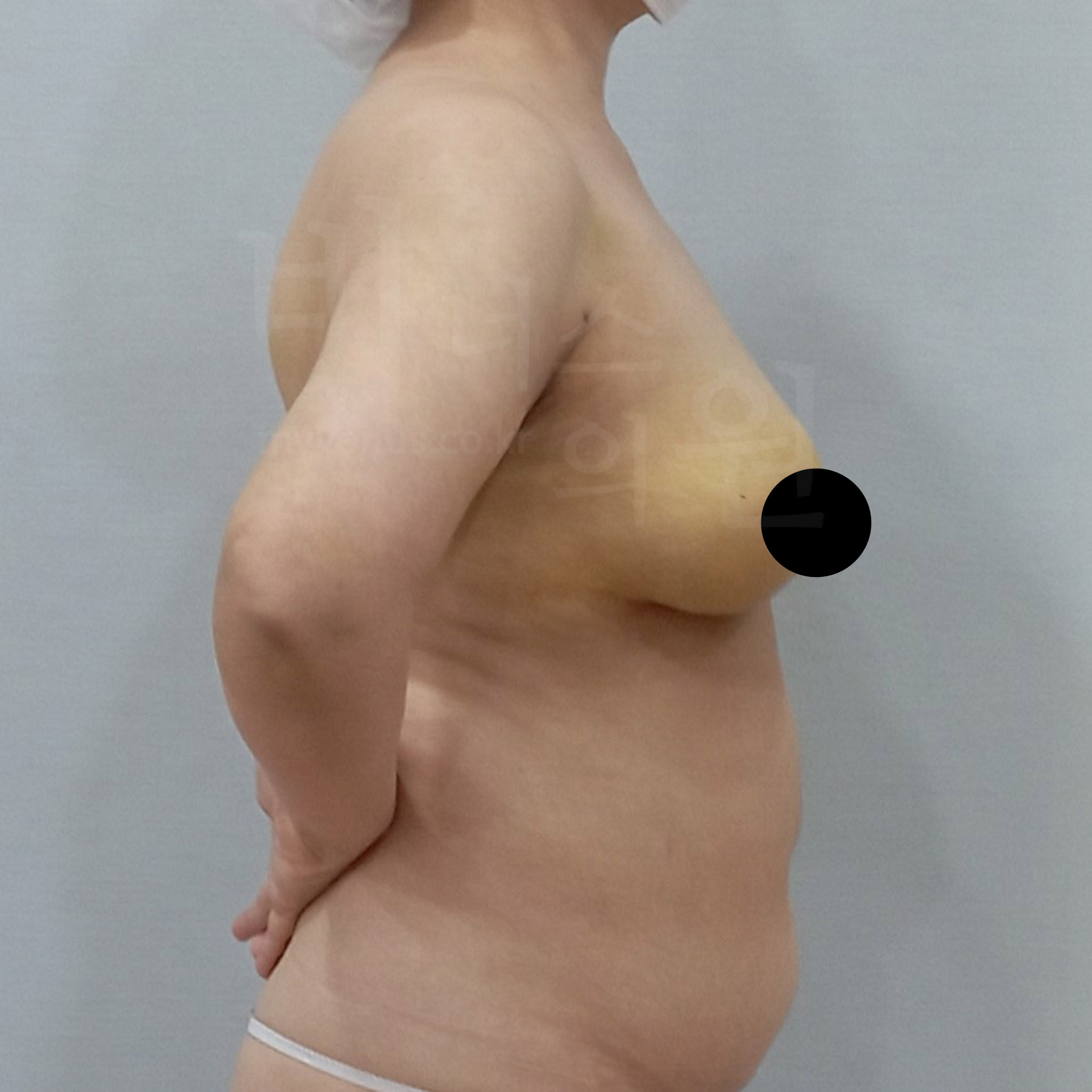 유방 지방흡입 사례.jpg