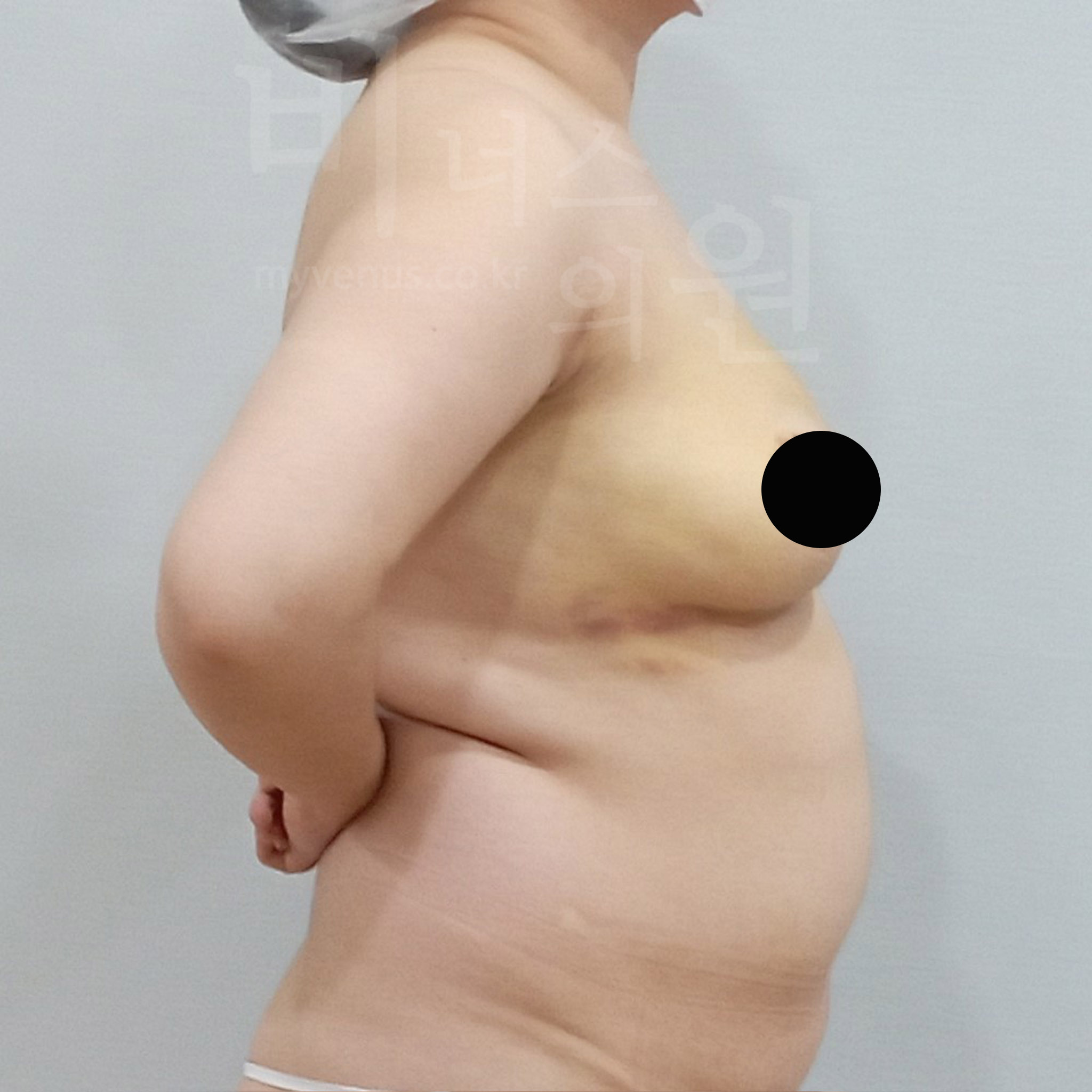 유방 리프팅.jpg