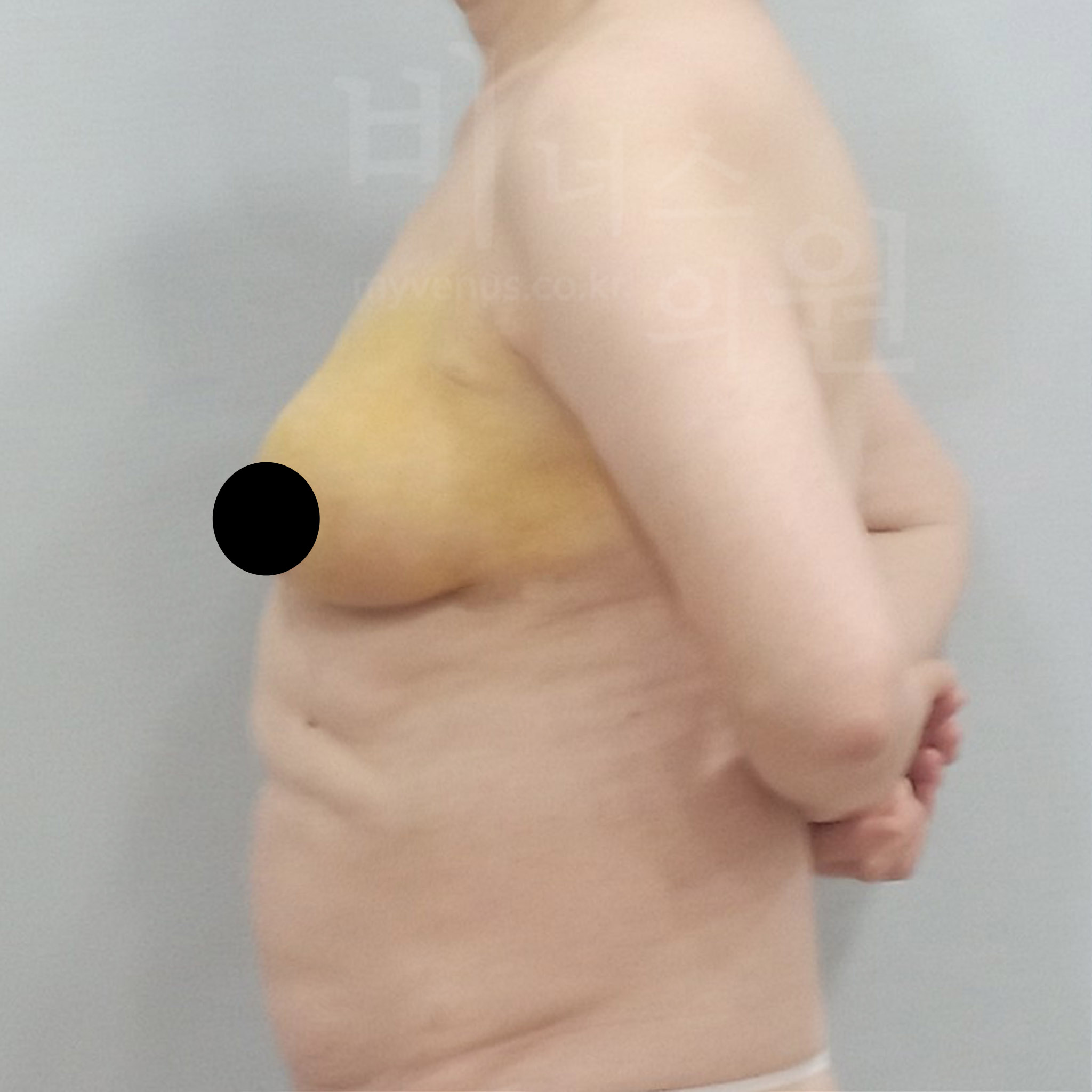 가슴 균형 맞추기.jpg