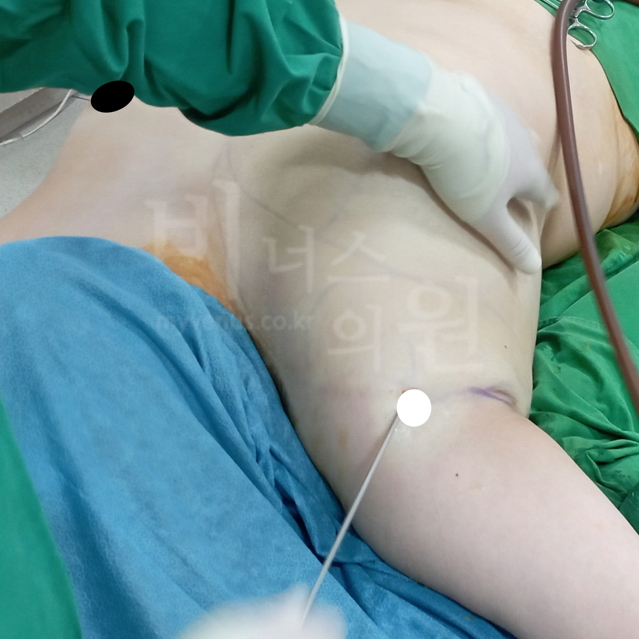 유방 지방흡입.jpg