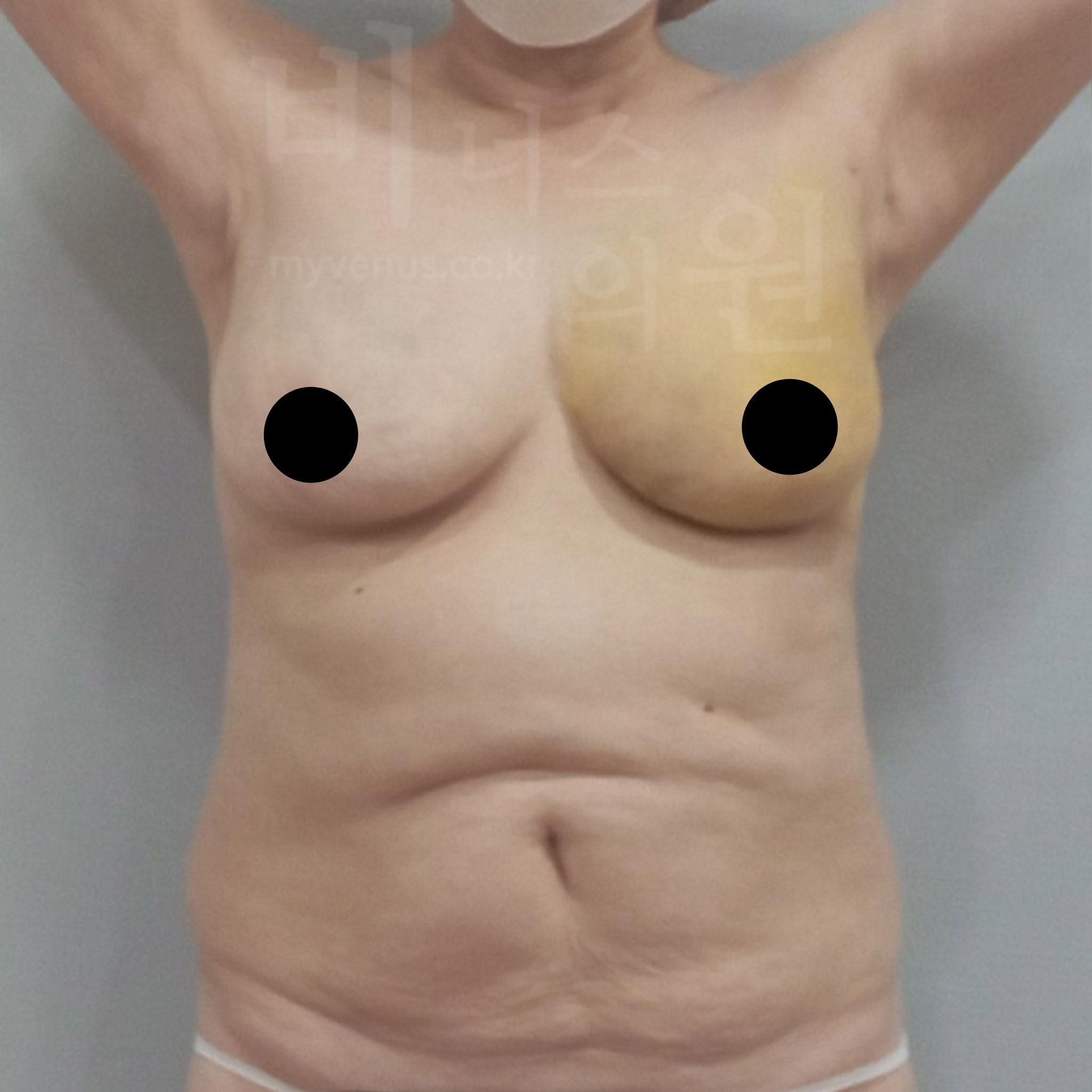 절개 없는 유방 축소.jpg