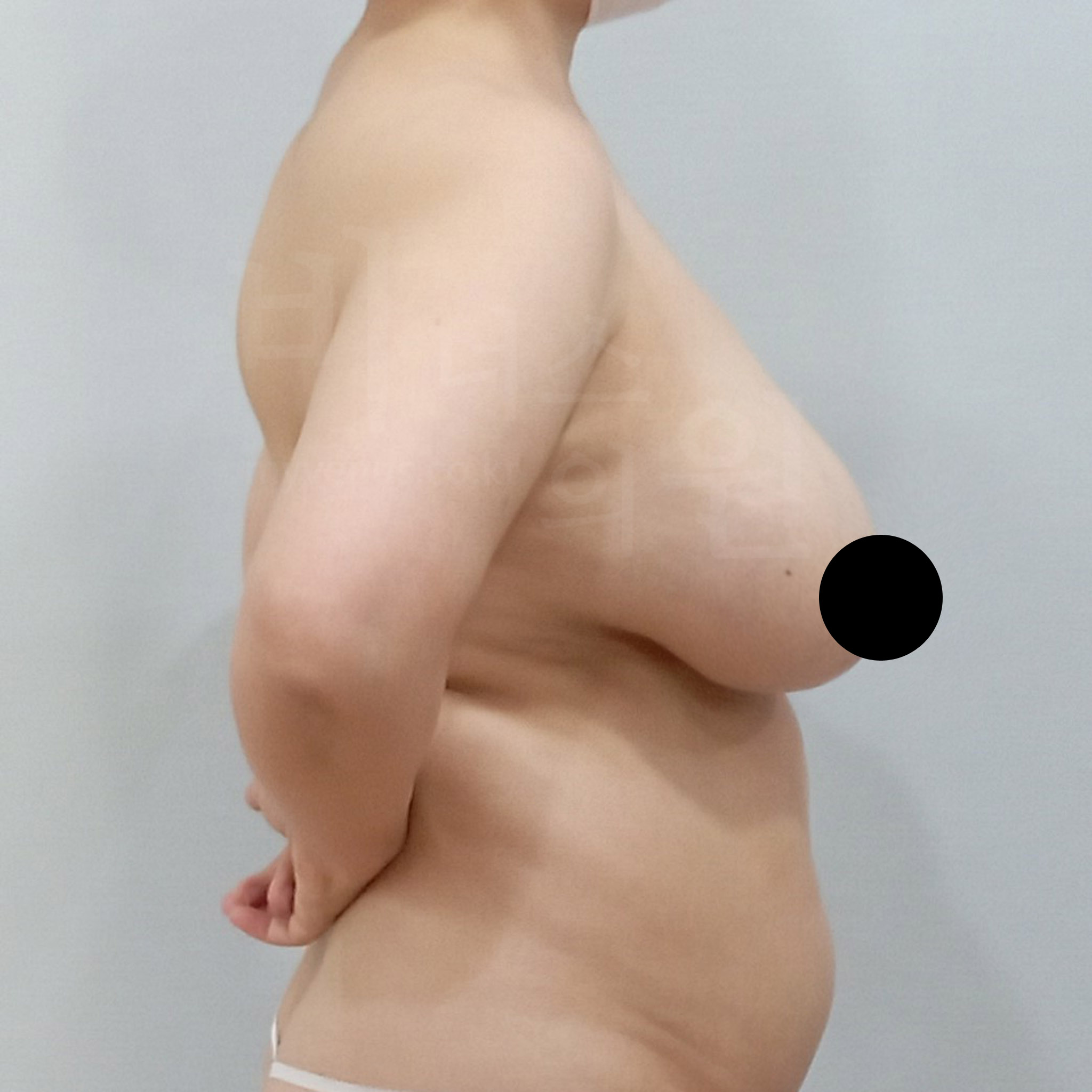 유방 수술 후기.jpg