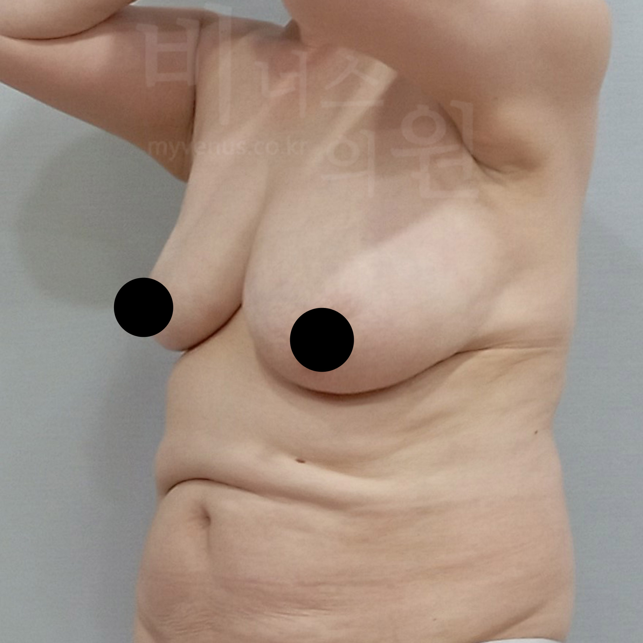 자연스러운 유방 교정.jpg