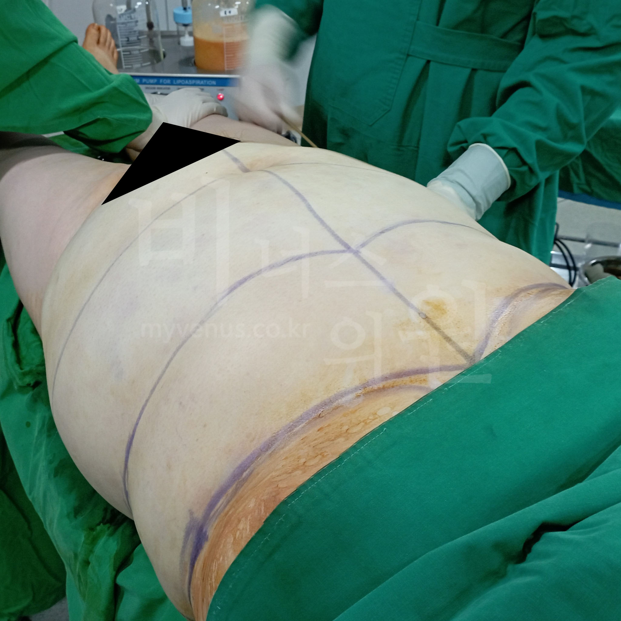 복부 라인 개선.JPG