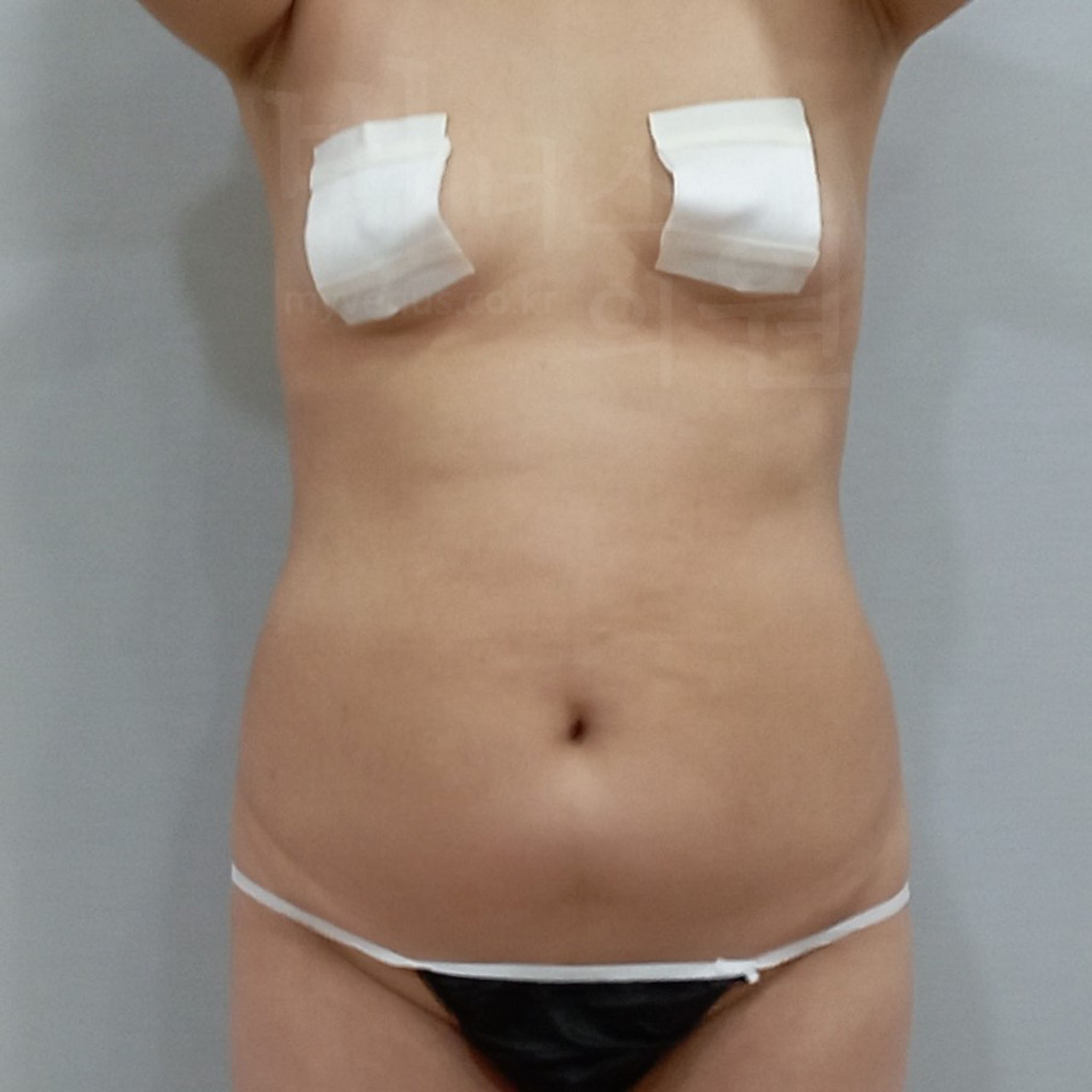 여성 복부 지방흡입.jpg