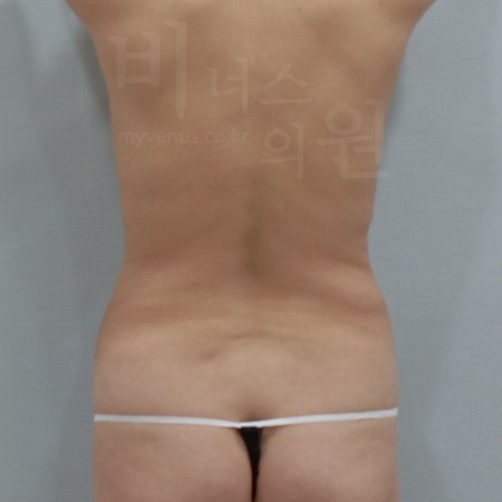 복부 라인 전후.jpg