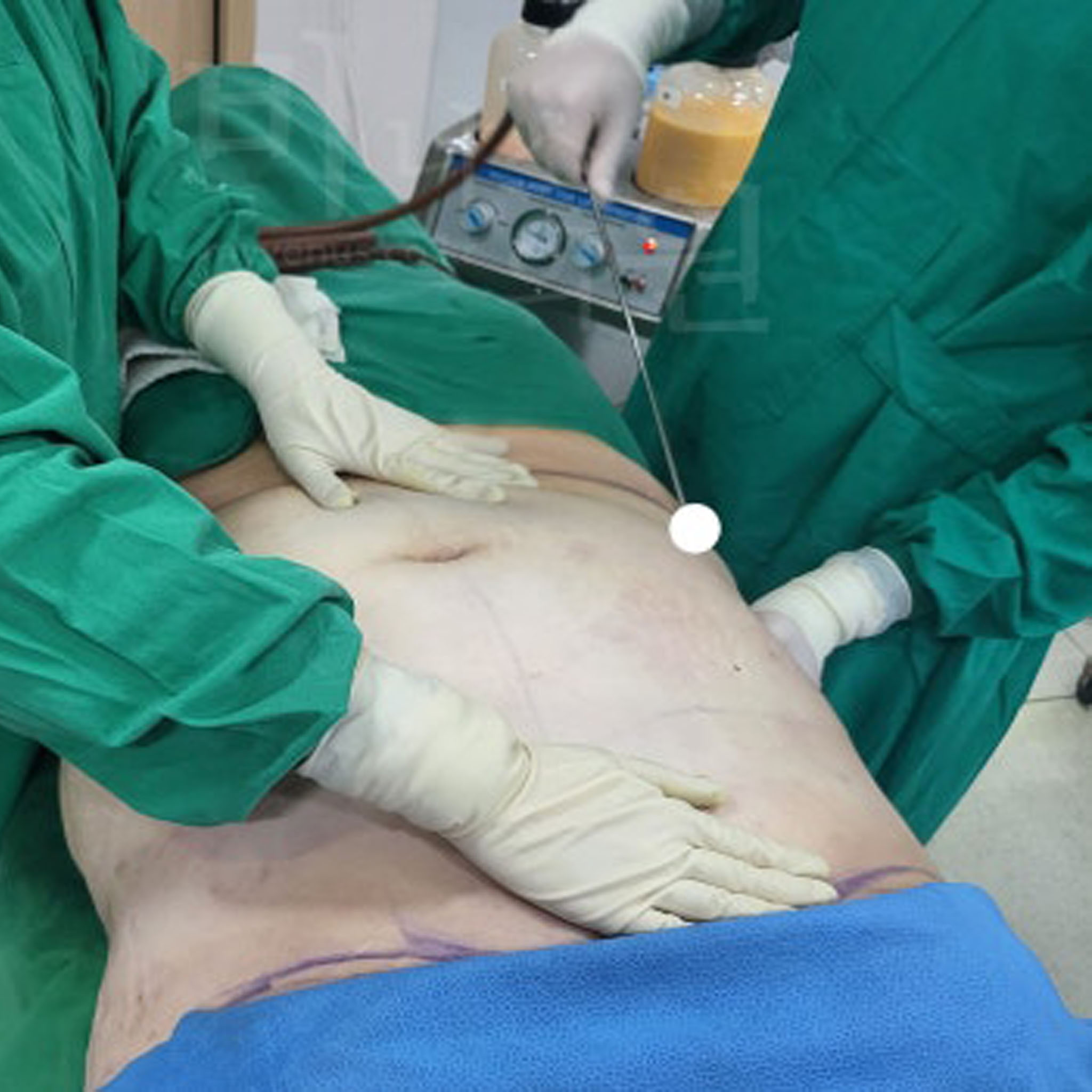 아랫배 지방흡입.JPG