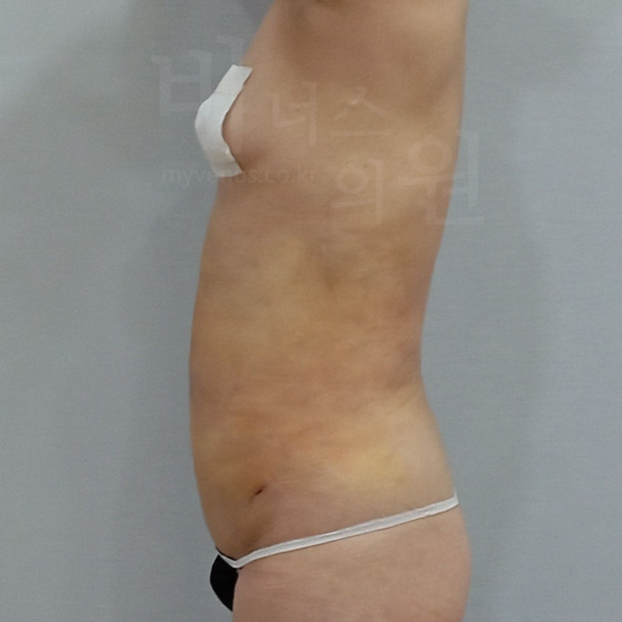 옆구리 지방 제거.jpg