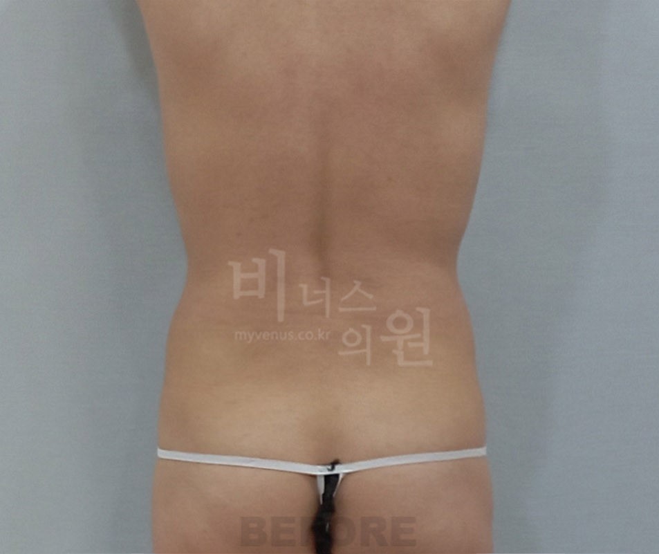 뱃살지방흡입_6.jpg