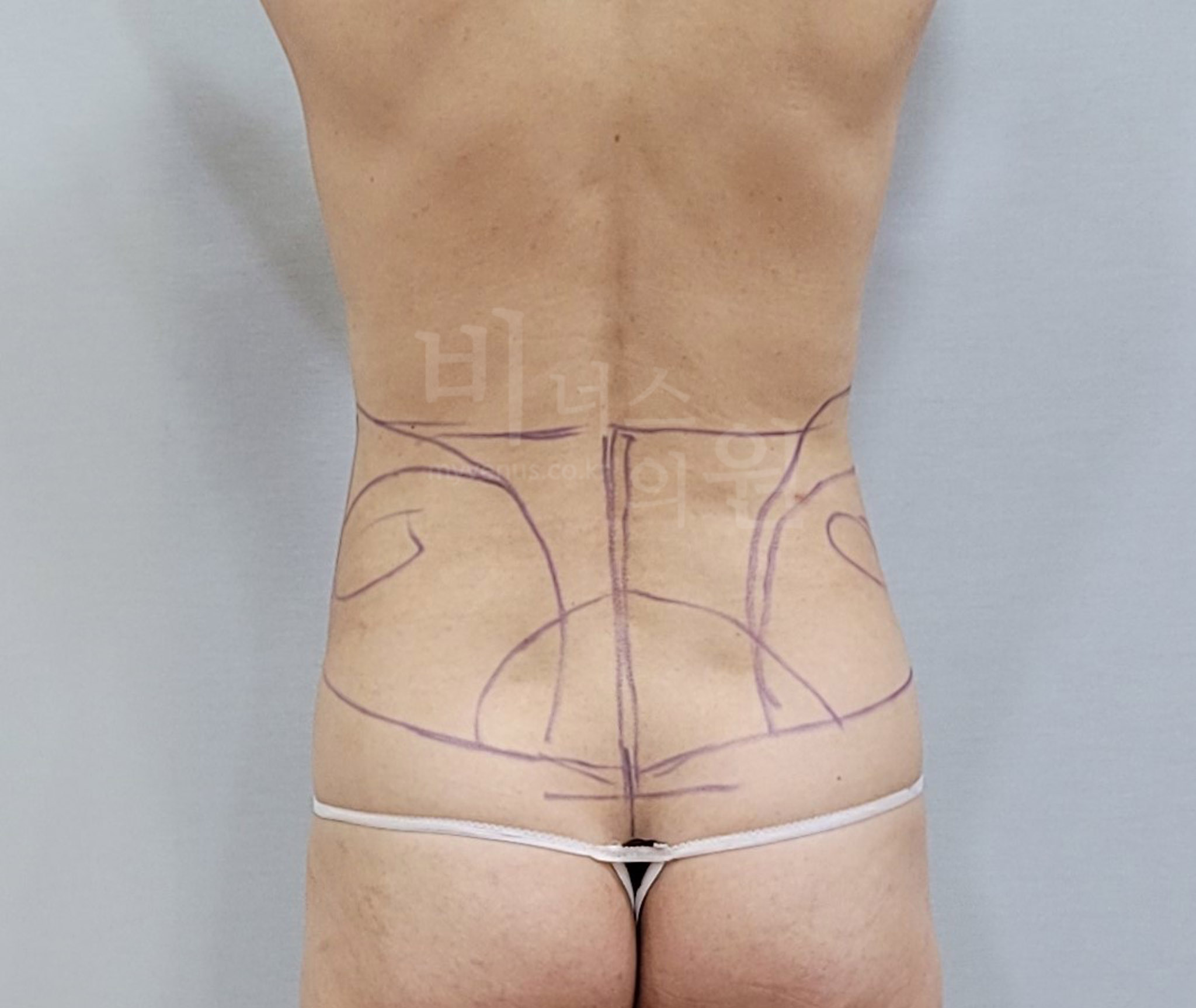 뱃살_지방흡입_12.jpg