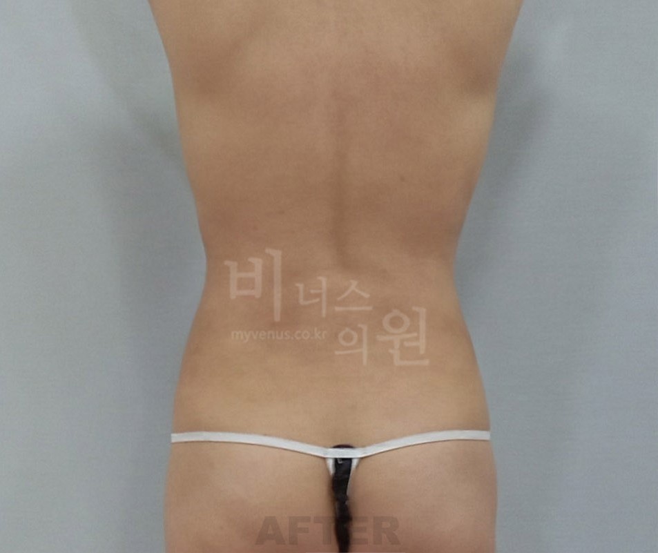 뱃살지방흡입_7.jpg