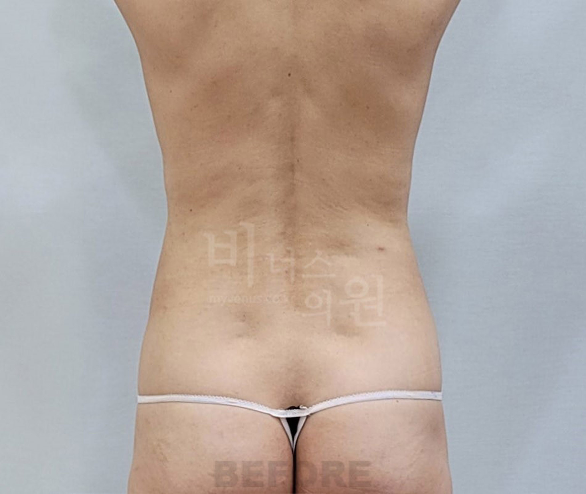 뱃살지방흡입_7.jpg