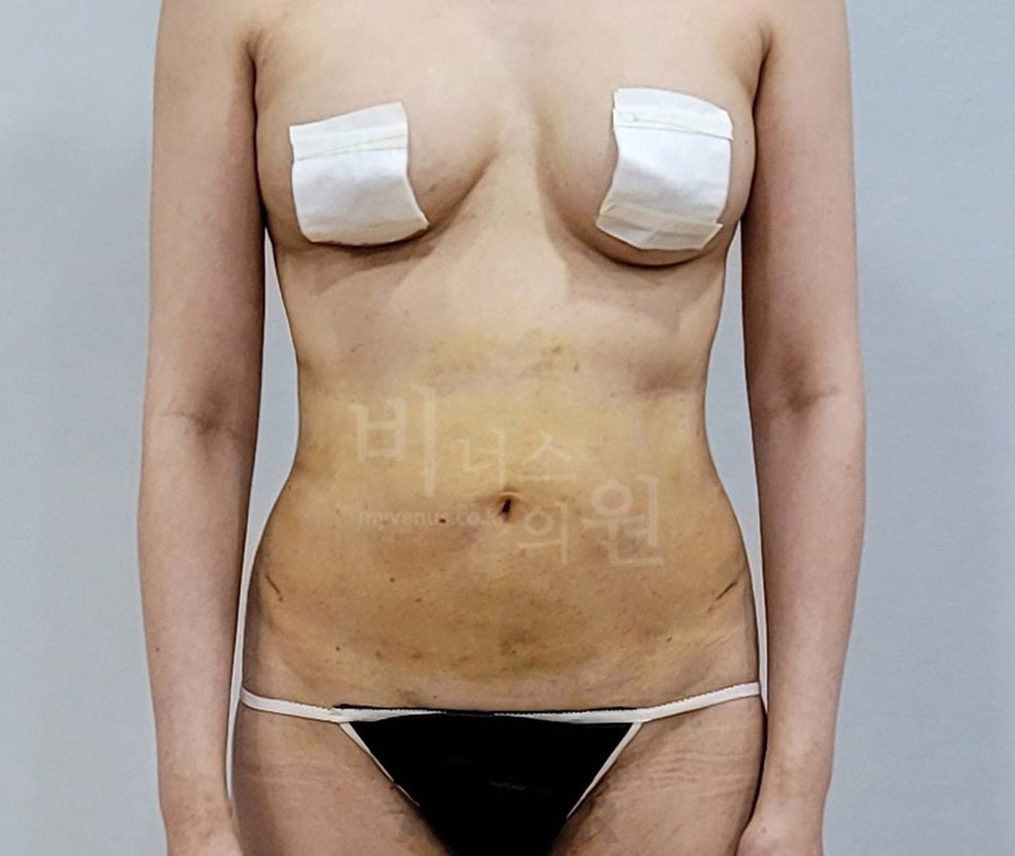 뱃살_지방흡입_1.jpg