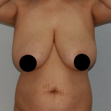 가슴지방흡입.jpg