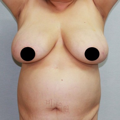 가슴지방흡입.jpg