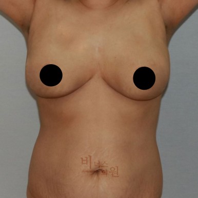 가슴지방흡입.jpg