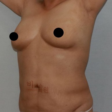가슴축소지방흡입.jpg