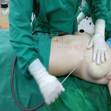 가슴지방흡입 축소.jpg