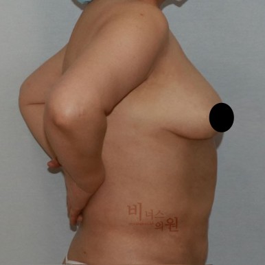 유방지방흡입.jpg